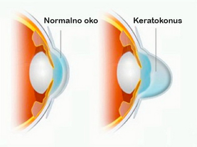 doznajte-koja-bolest-na-ocite-se-lekuva-so-metodata-kros-linking-1.jpg