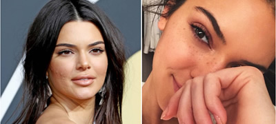 najdobrite-soveti-za-borba-protiv-akni-spored-dermatologot-na-kendal-jenner-povekje01.jpg