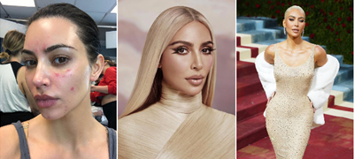 kim-kardashijan-za-ekstremnata-dieta-dobiv-psorijaza-po-celoto-telo-ne-mozhev-da-gi-mrdam-racete-no-kje-napravam-s-za-da-bidam-ubava-povekje-01.jpg