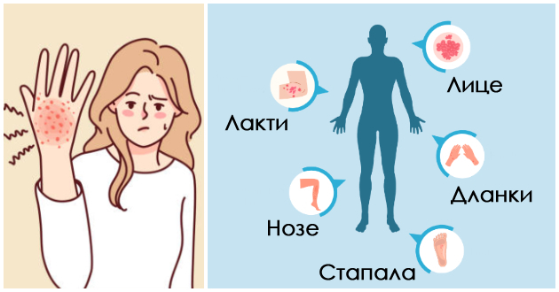 stres-genetika-shto-ja-predizvikuva-egzemata-i-mozhe-li-da-se-izlechi-01.jpg