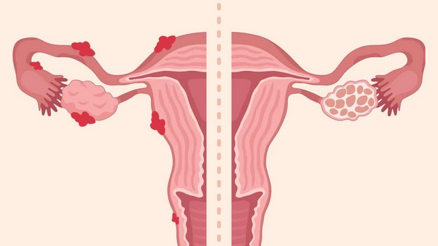 shto-e-retrogradna-menstruacija-i-dali-predizvikuva-endometrioza-6.JPG