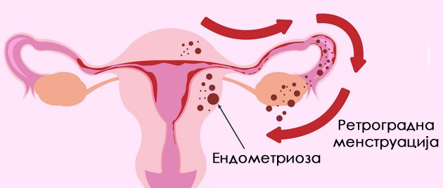 shto-e-retrogradna-menstruacija-i-dali-predizvikuva-endometrioza-8.jpg