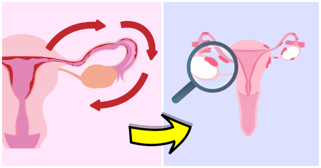 shto-e-retrogradna-menstruacija-i-dali-predizvikuva-endometrioza01.jpg