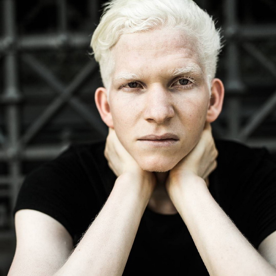 Фотографии альбиносов